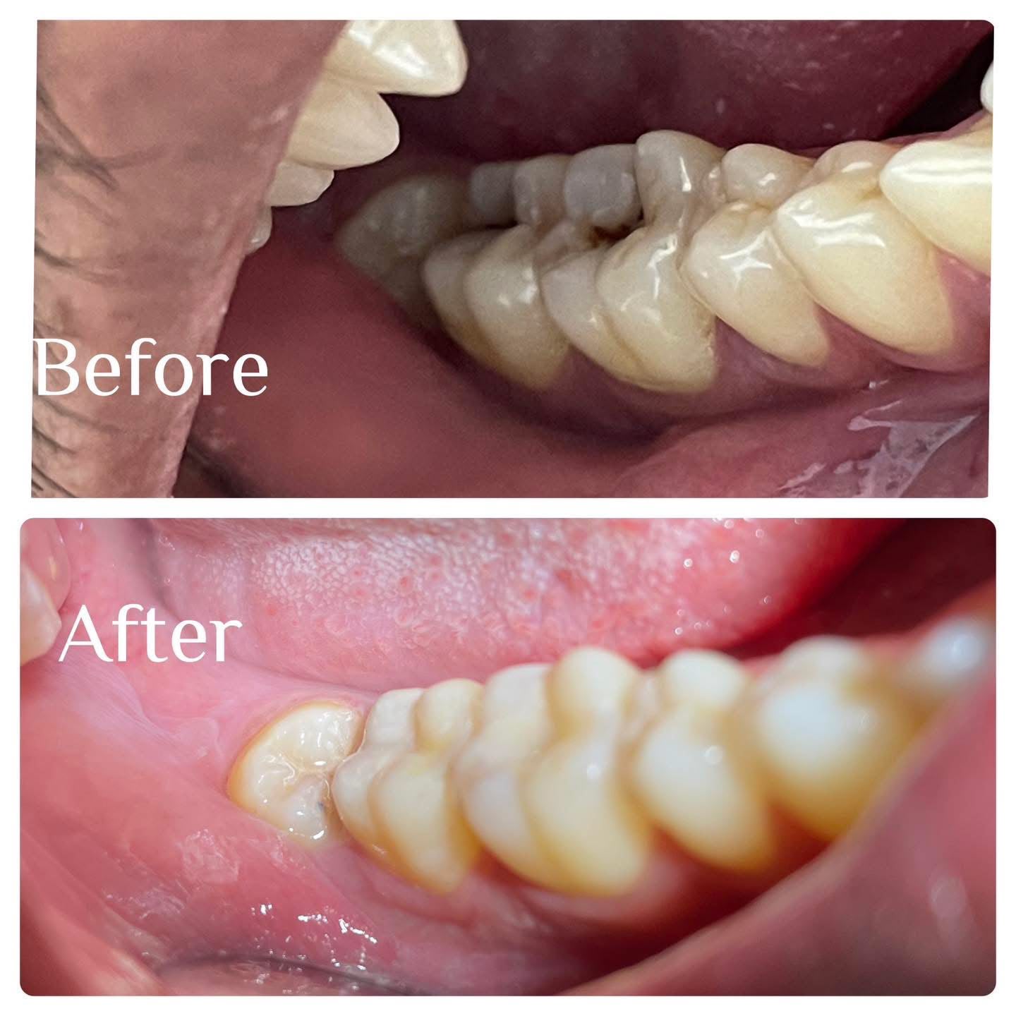 Before scaling and polishing