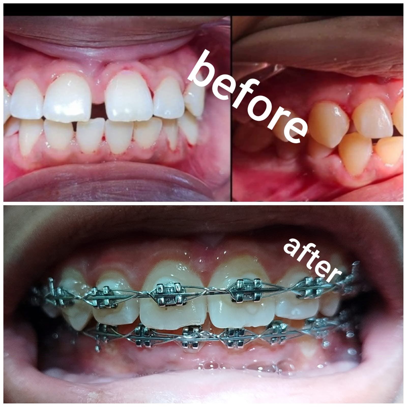 After crown fitting
