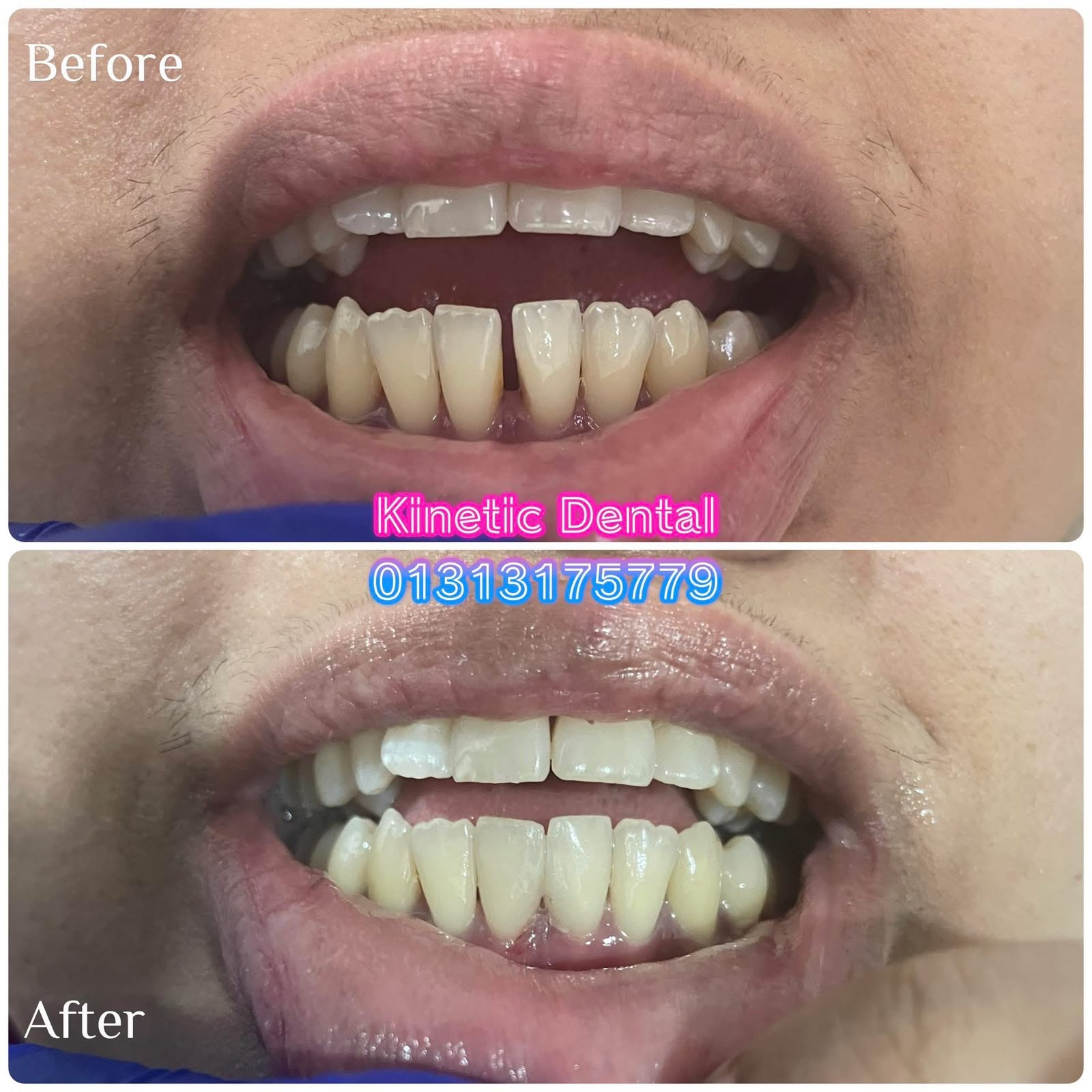 Before gap closure