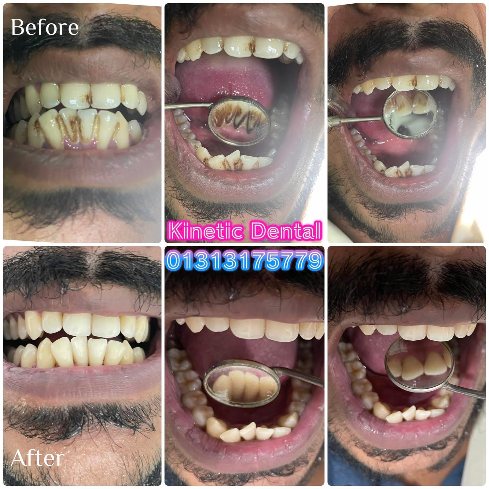 After gap closure