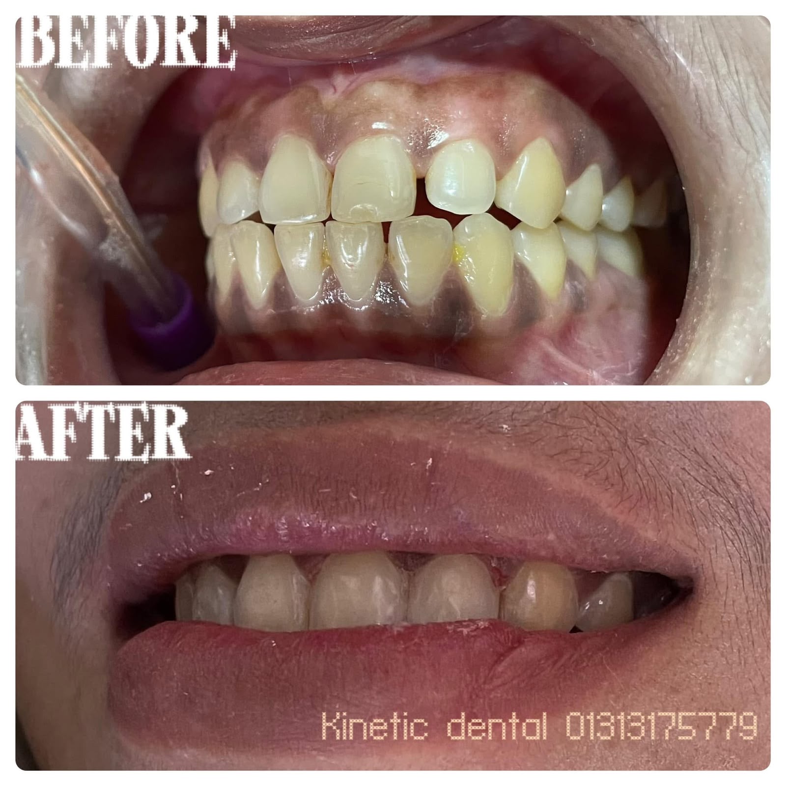 Before root canal treatment
