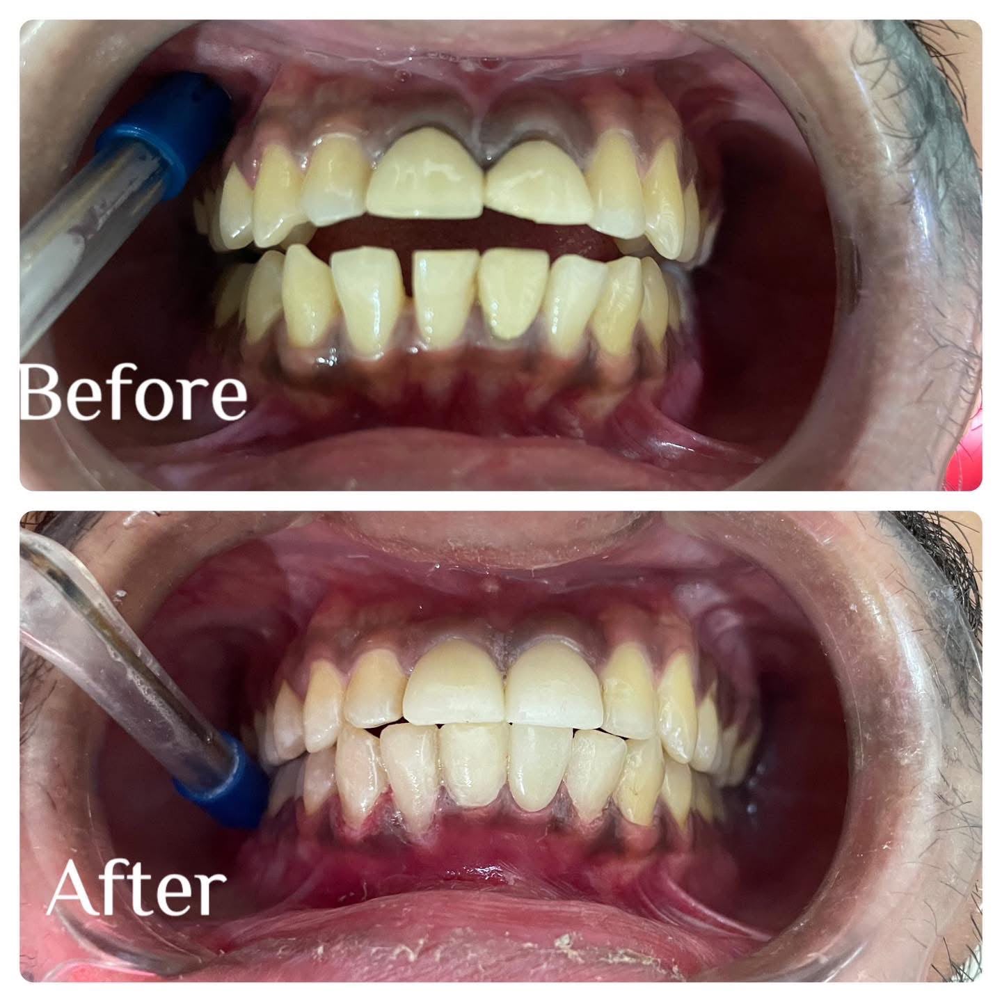 After root canal treatment