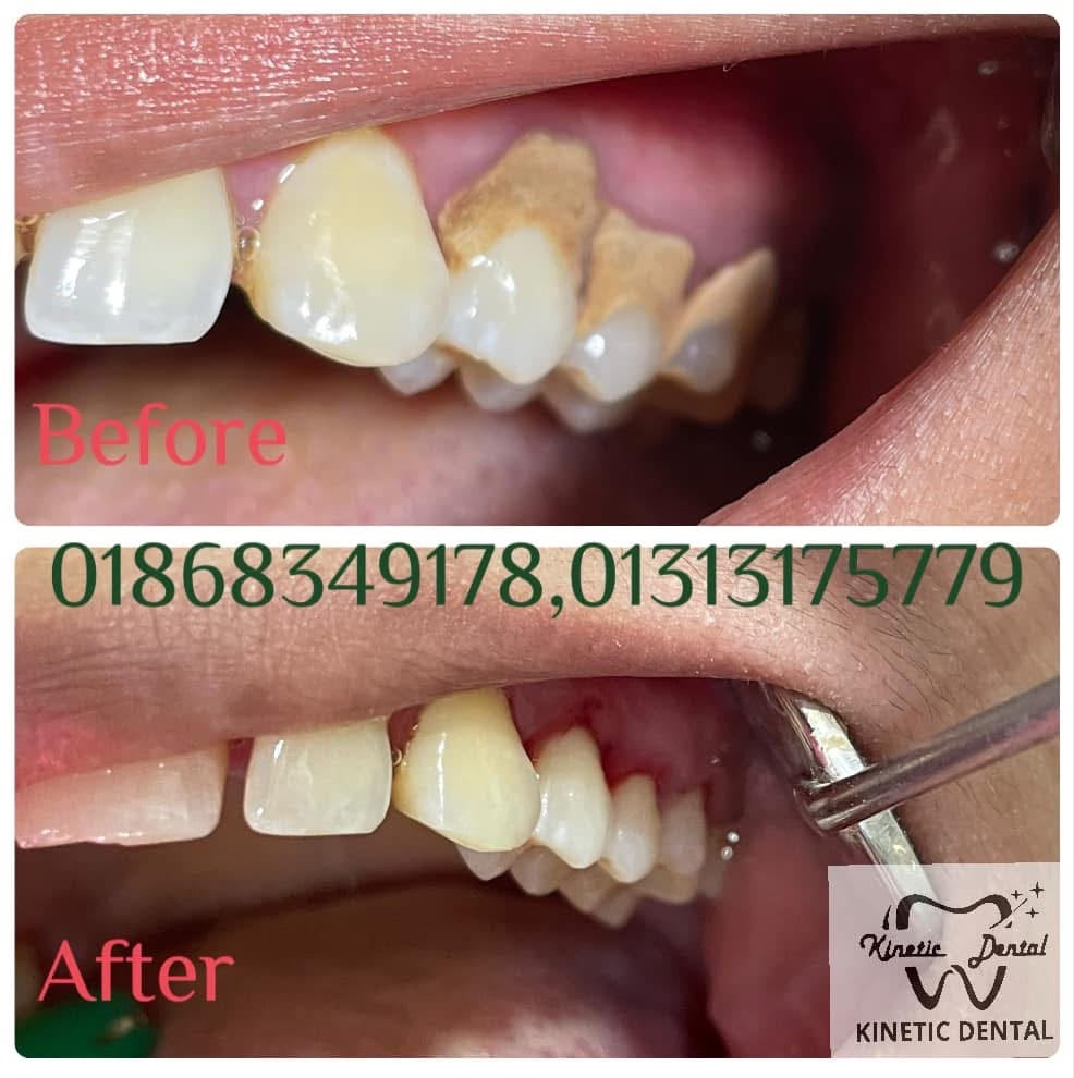 Before braces alignment