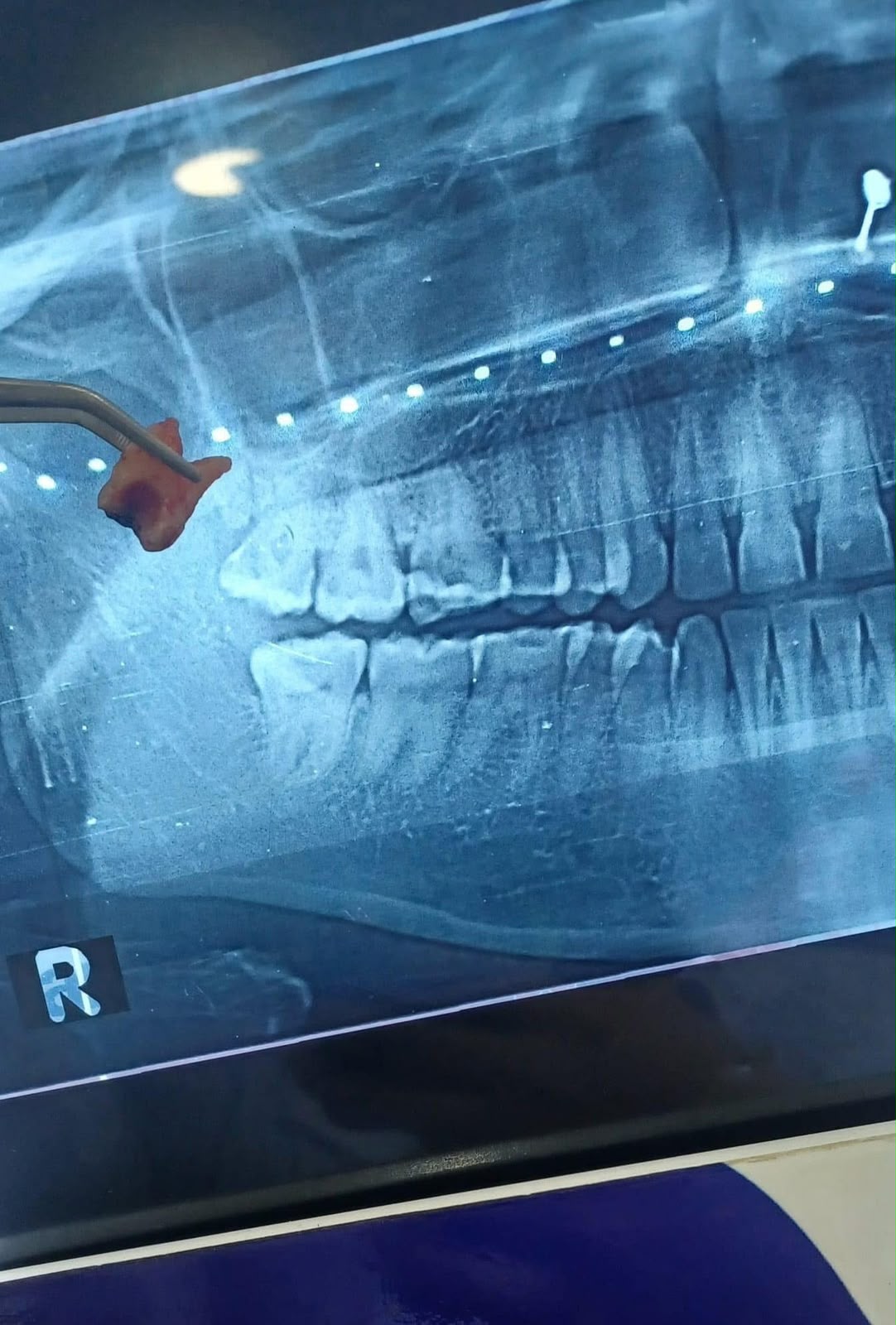 After braces alignment