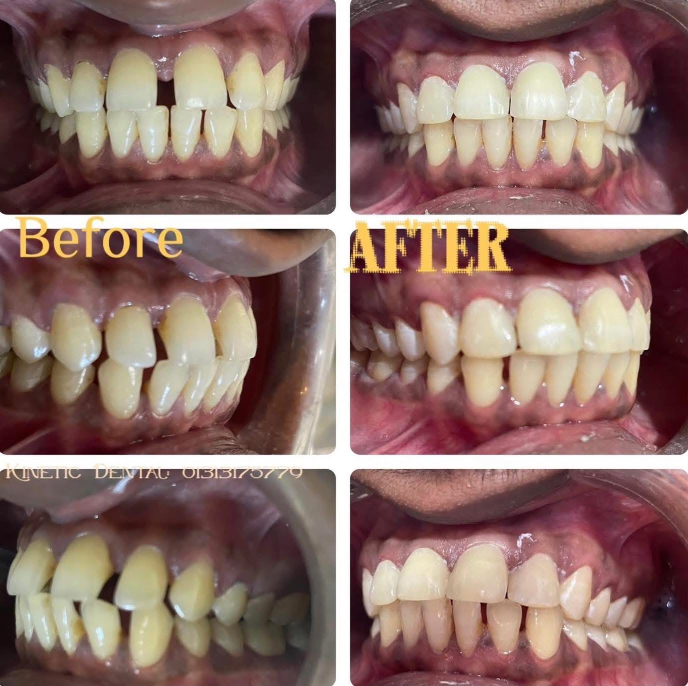 Before crown fitting